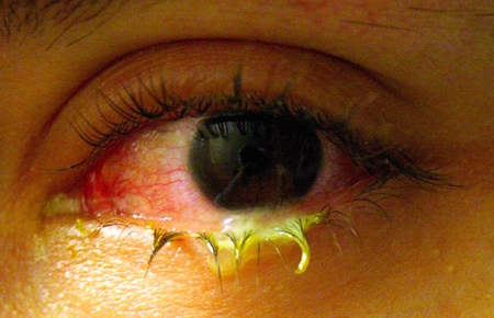  Can contact lenses cause eye infections?